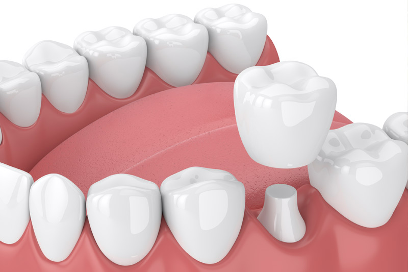 Dental Crowns in Carmel