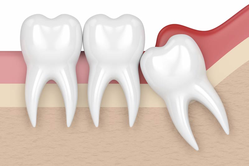 Wisdom Tooth Removal in Carmel